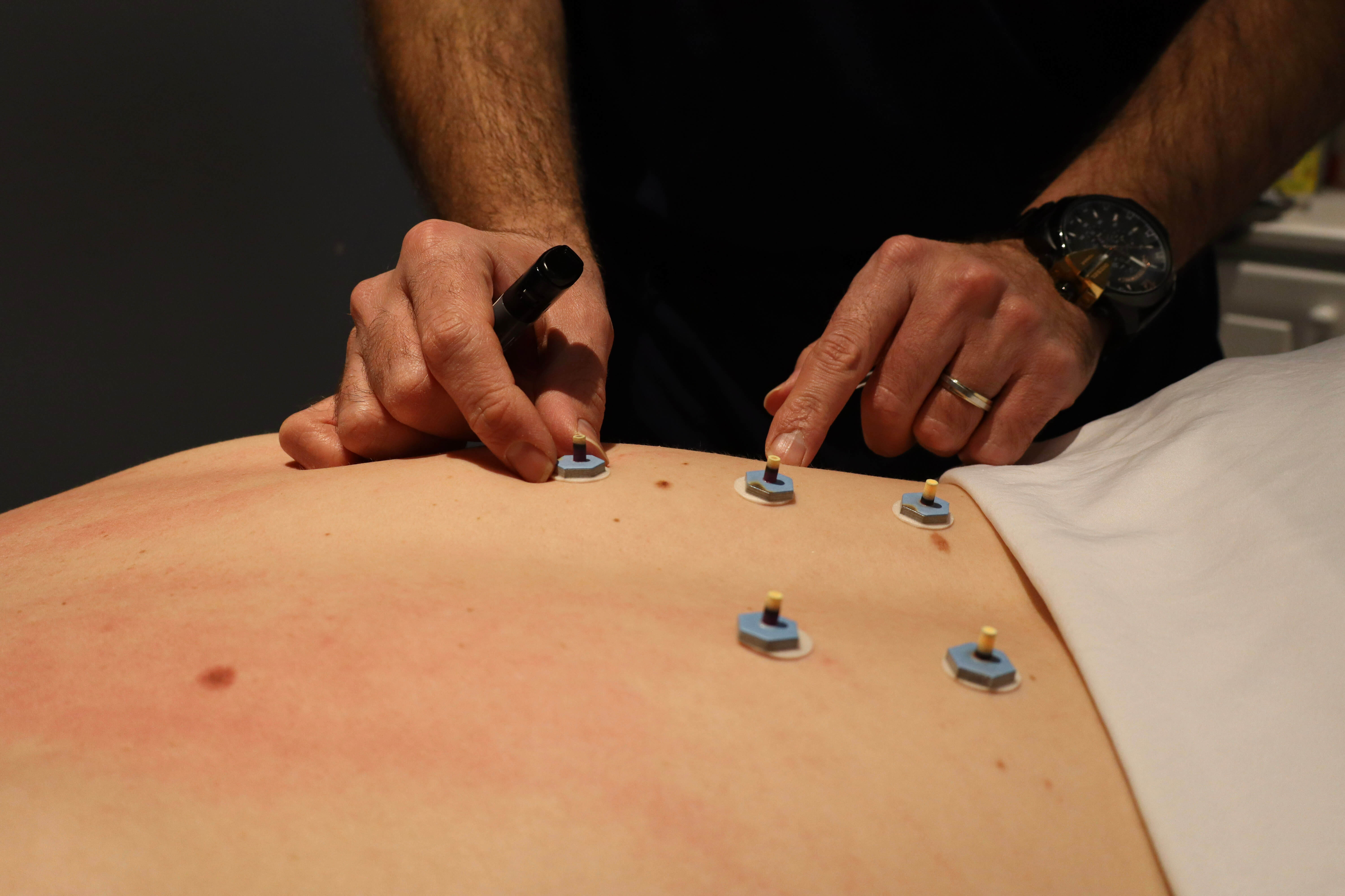 Naturopathic treatment at Perfect Posture