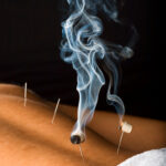 Patient receiving acupuncture treatment to his back